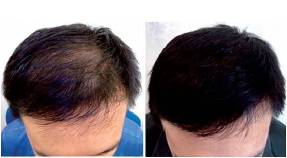 ABS 650nm Hair Regrowth Laser Cap 1360mW Anti Hair Loss 5mW