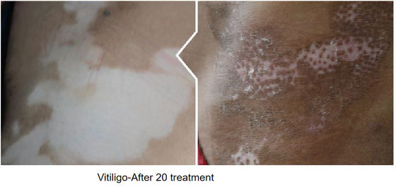 Homeuse 308nm Vitiligo Excimer Laser Targeted Treatment Excimer Light