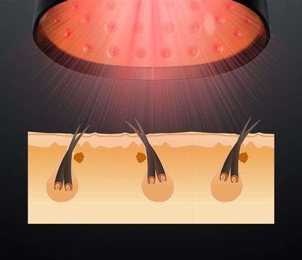 ABS 81 Diodes Laser Hair Loss Treatment HairPro Laser Therapy Cap